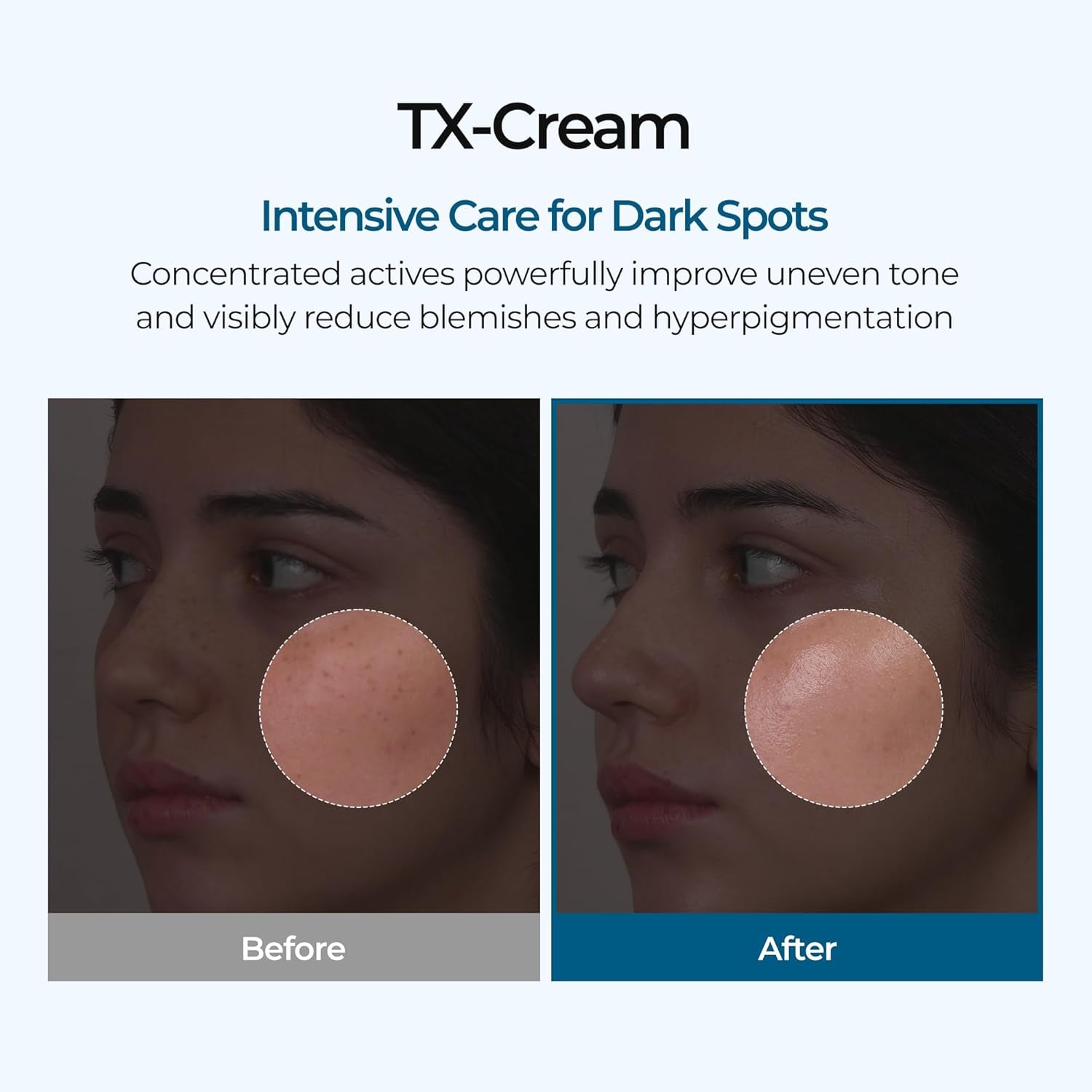 GlowFade™ TX Tranexamic Acid Cream – Korean Anti-Pigmentation &amp; Freckle Corrector for Clear, Even-Toned Skin (50ml)